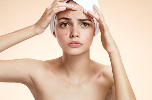 10% azelaic acid essence, your ultimate solution to acne and acne marks