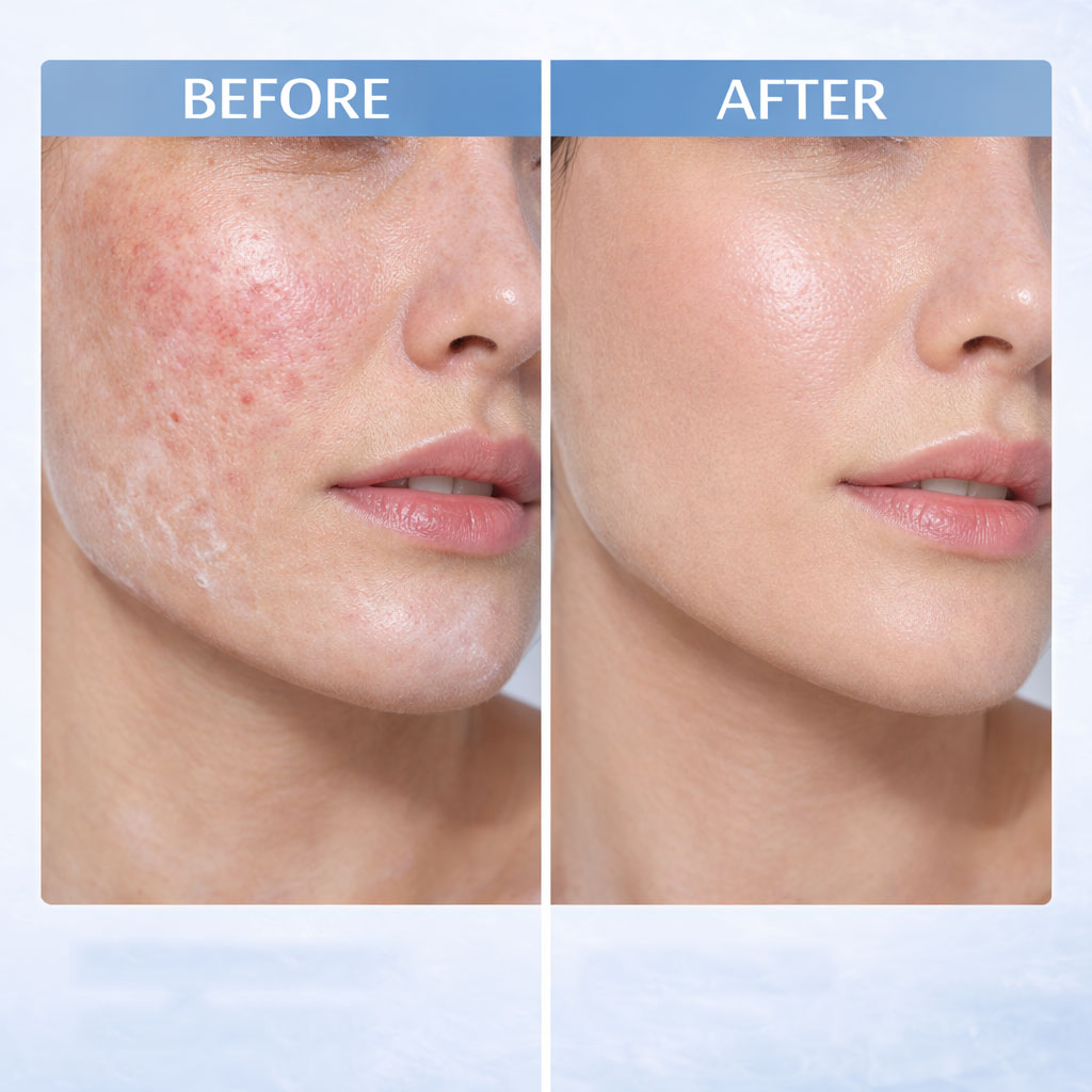 Effect After Using For Hyalu-Cica Water-Fit UVA UVB SPF50 Sun Serum Sunscreen