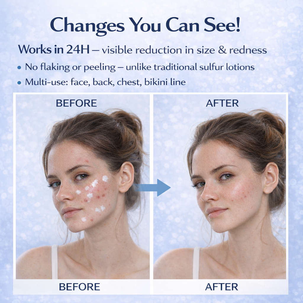 OEM 15ML Salicylic Acid Sulfur Niacinamide 24H Spot Rescue Acne Lotion